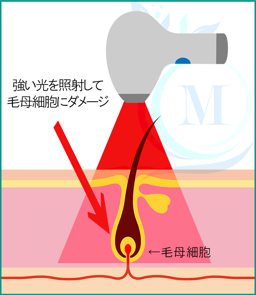 ミントの脱毛方法 土岐店 脱毛サロンmint ミント